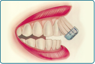 Cepillado1