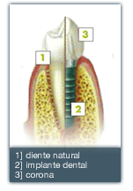 Implantes